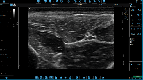 B Mode: Median Nerve Cross-Section