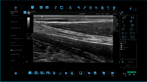 B Mode Median Nerve Long Axis