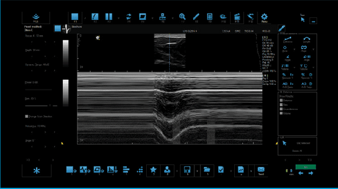 M Mode: Diaphragm with Phrenic Nerve Stim