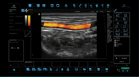 Needle Injection with PDI Doppler